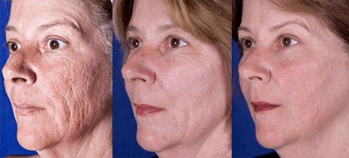 نتیجه بعد از روش جوان سازی پوست صورت با لیزر
