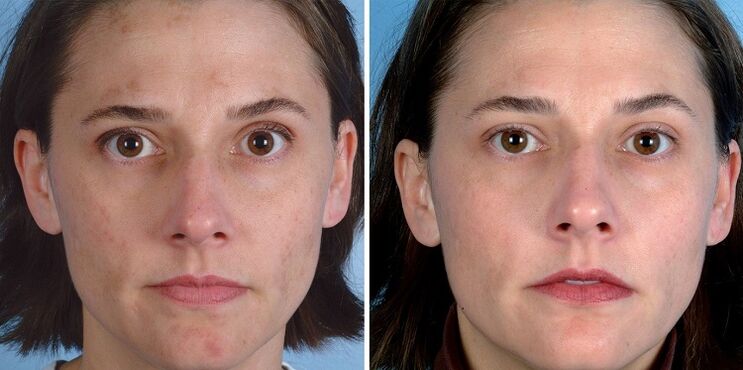 قبل و بعد از جوان سازی پوست با دستگاه