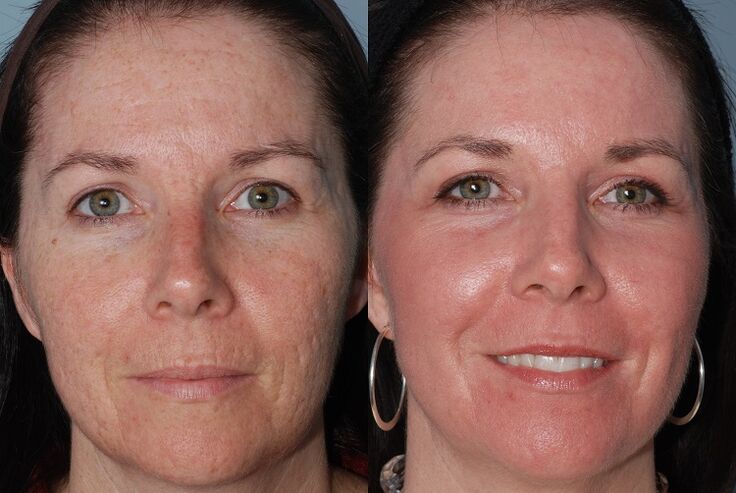 قبل و بعد از جوان سازی پوست سخت افزار
