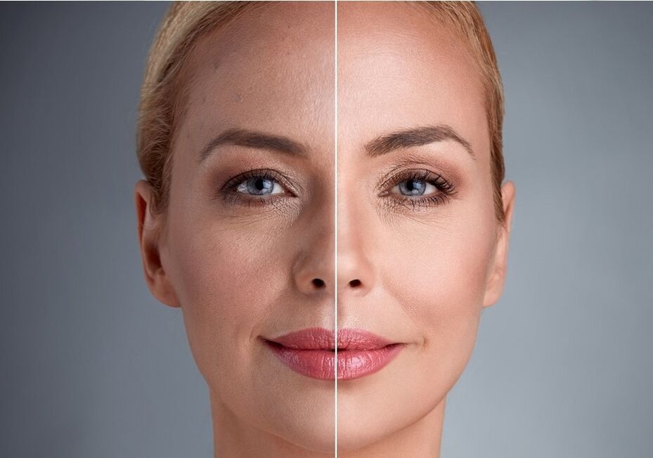 قبل و بعد از جوانسازی صورت با لیزر