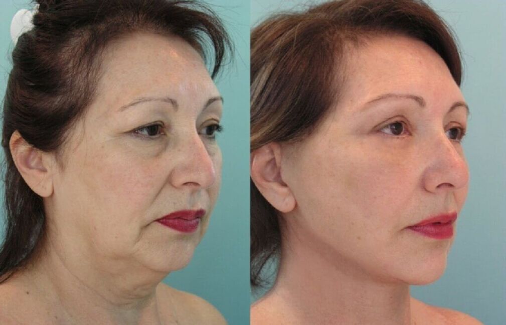 عکس قبل و بعد از جوانسازی پوست