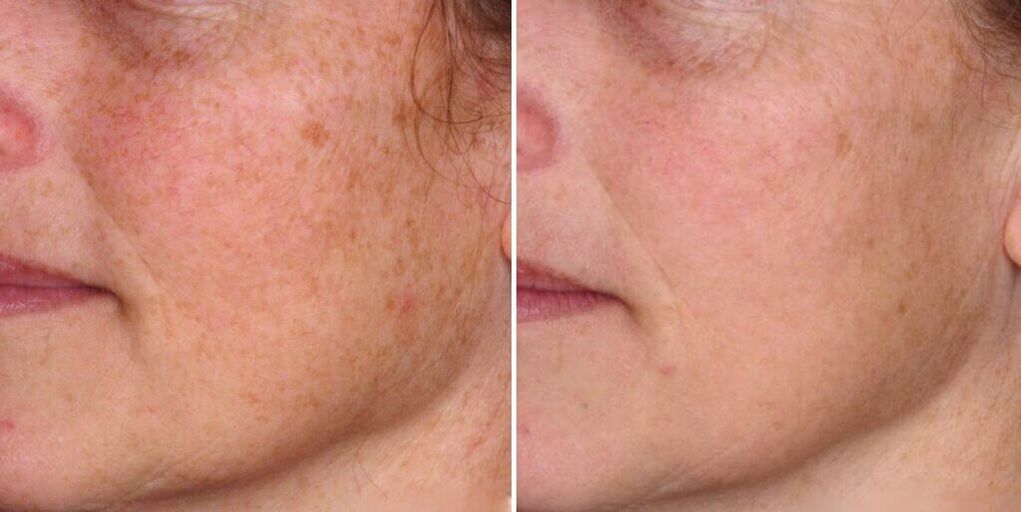 پوست صورت قبل و بعد از جوانسازی